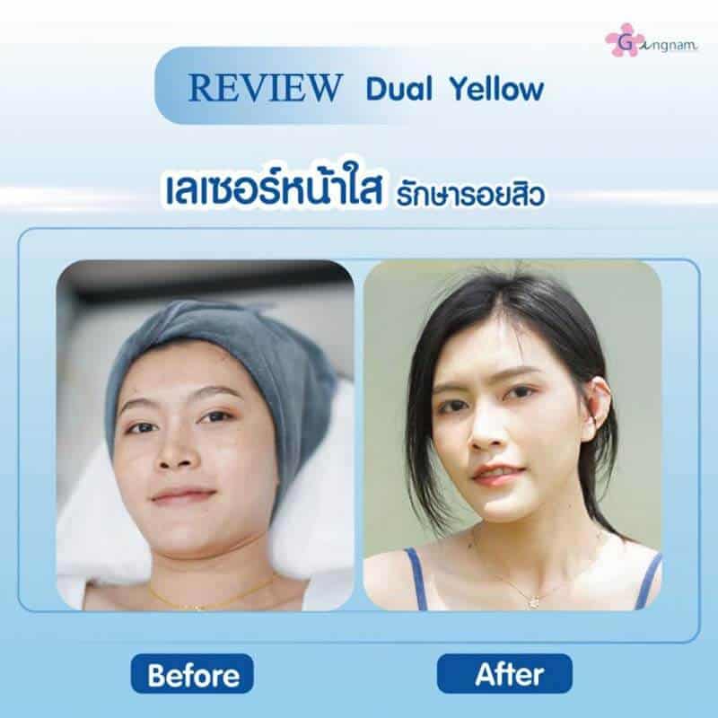 รีวิวเลเซอร์หน้าใส ด้วยแสง dual yellow