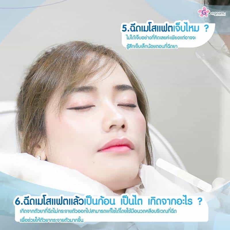 ฉีดเมโสแฟต-มีอาการเจ็บไหม