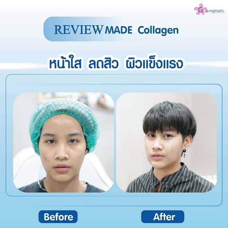 ฉีดมาเด้คอลาเจนบำรุงผิวลดสิว