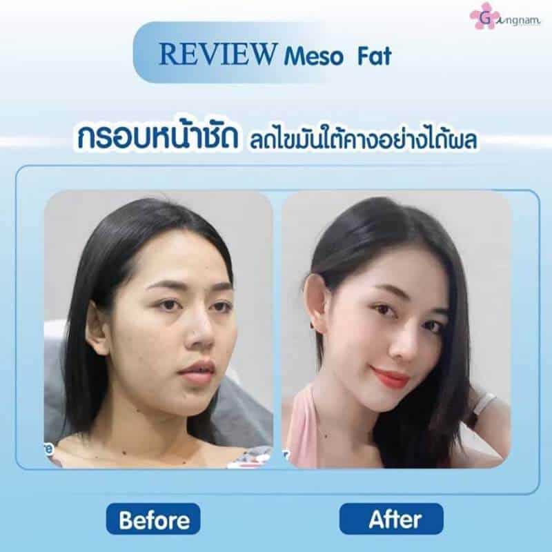 ฉีดแฟต (Meso Fat) คืออะไร ฉีดสลายไขมันจุดไหนได้บ้าง เหมาะกับใคร ฉีดแฟต (Meso Fat) คืออะไร ฉีดสลายไขมันจุดไหนได้บ้าง เหมาะกับใคร