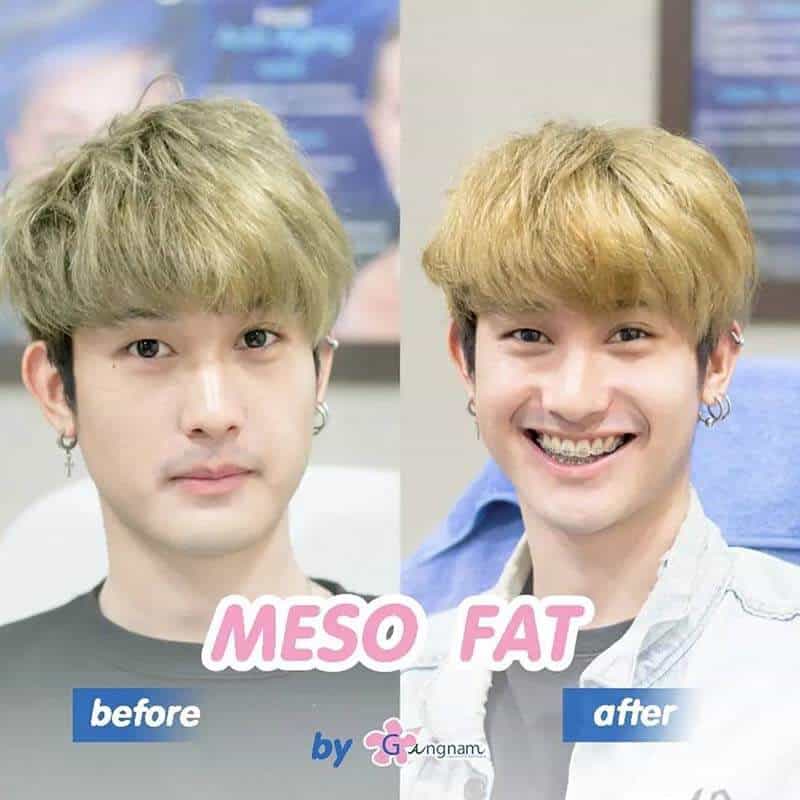 การฉีดเมโสแฟต ข้อดี ข้อเสีย ในปัจจุบัน_02
