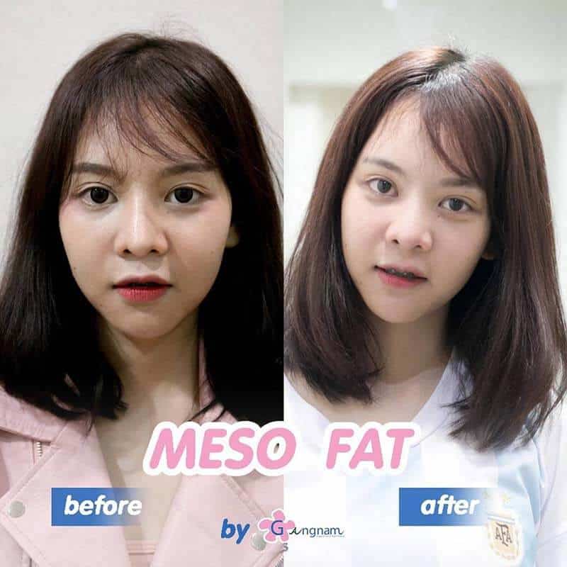 การฉีดเมโสแฟต ข้อดี ข้อเสีย ในปัจจุบัน_05