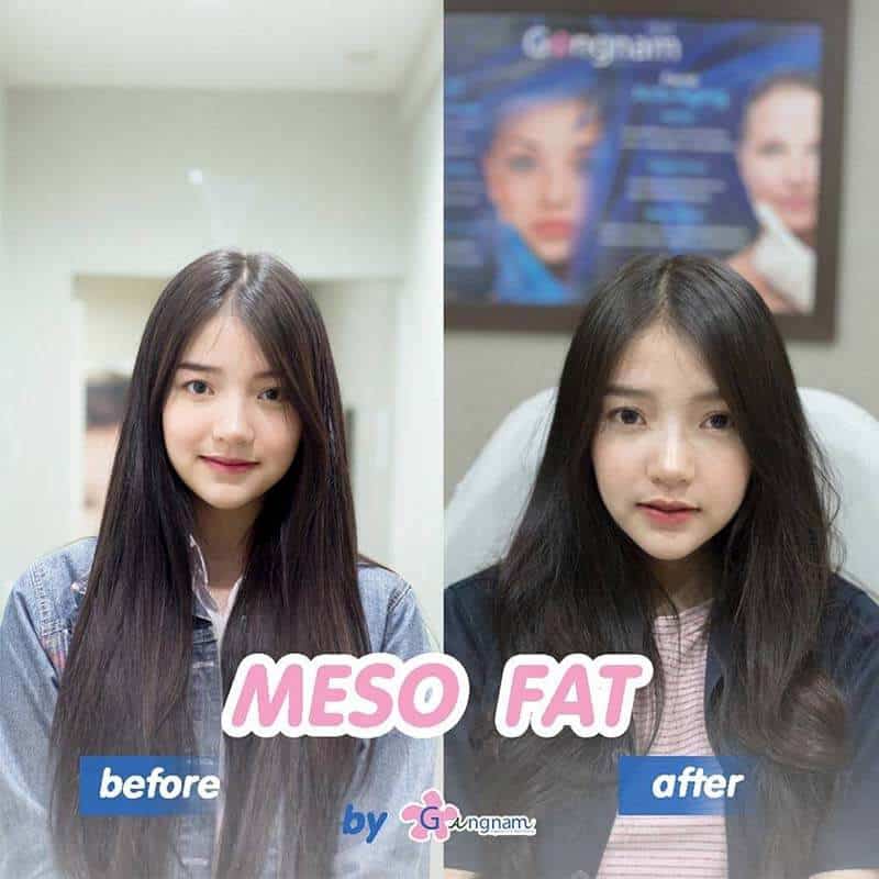 รีวิวหลังฉีดเมโสแฟต Before After
