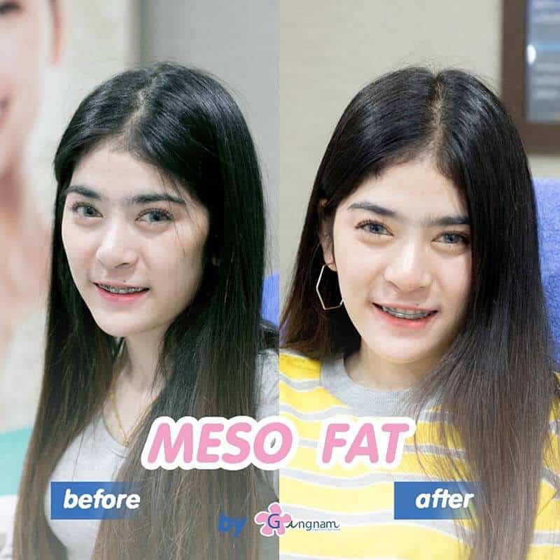 รีวิว Before After หลังฉีดแฟต