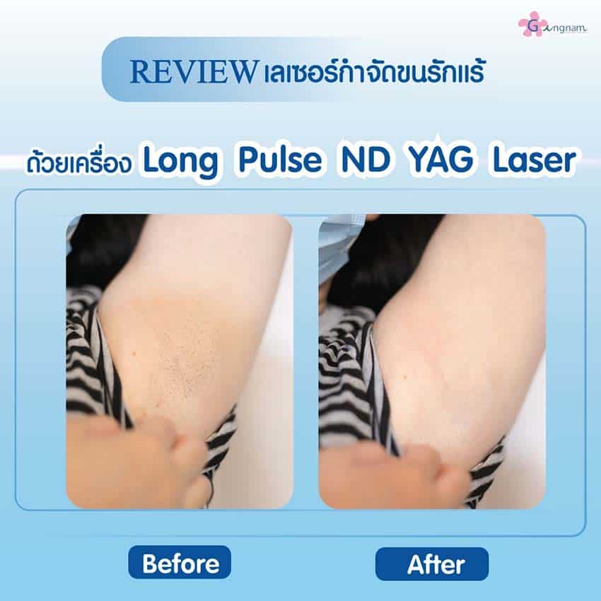กำจัดขนรักแร้ด้วย Long Pulse ND Yag
