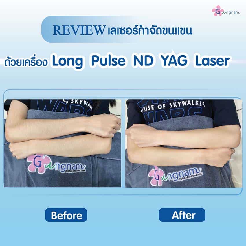 กำจัดขนแขนด้วยเครื่อง Long Pulse ND Yag