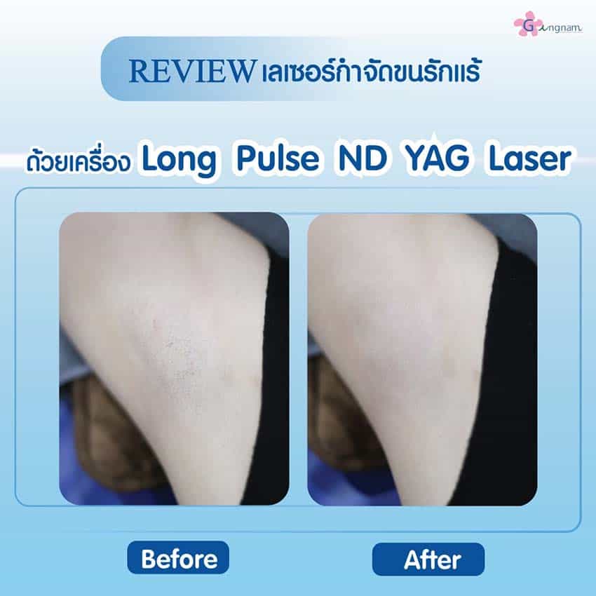 10 วิธีกําจัดขนรักแร้ ไม่ให้เป็นตอ ข้อดี-ข้อเสีย วิธีไหนให้ผลลัพธ์ถาวร แบบธรรมชาติ 10 วิธีกําจัดขนรักแร้ ไม่ให้เป็นตอ ข้อดี-ข้อเสีย วิธีไหนให้ผลลัพธ์ถาวร แบบธรรมชาติ