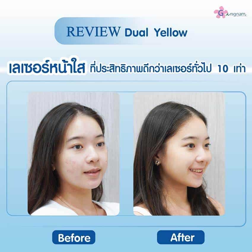 รีวิว Dual Yellow laser บำรุงผิวหน้า