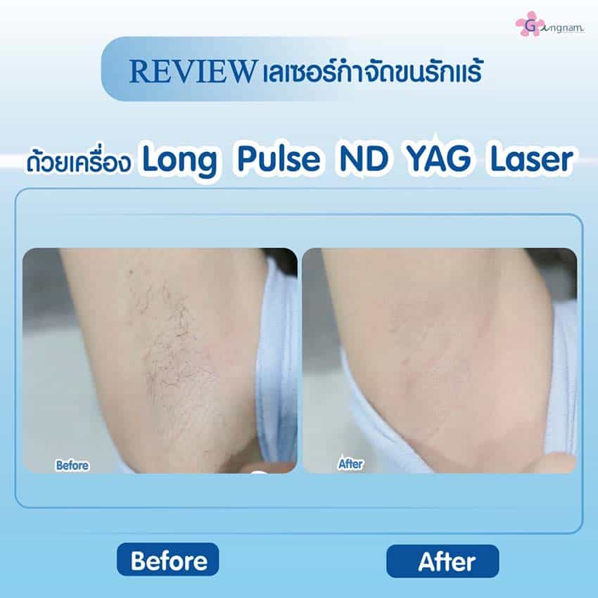 รีวิว Long Pulse ND Yag กำจัดขนรักแร้