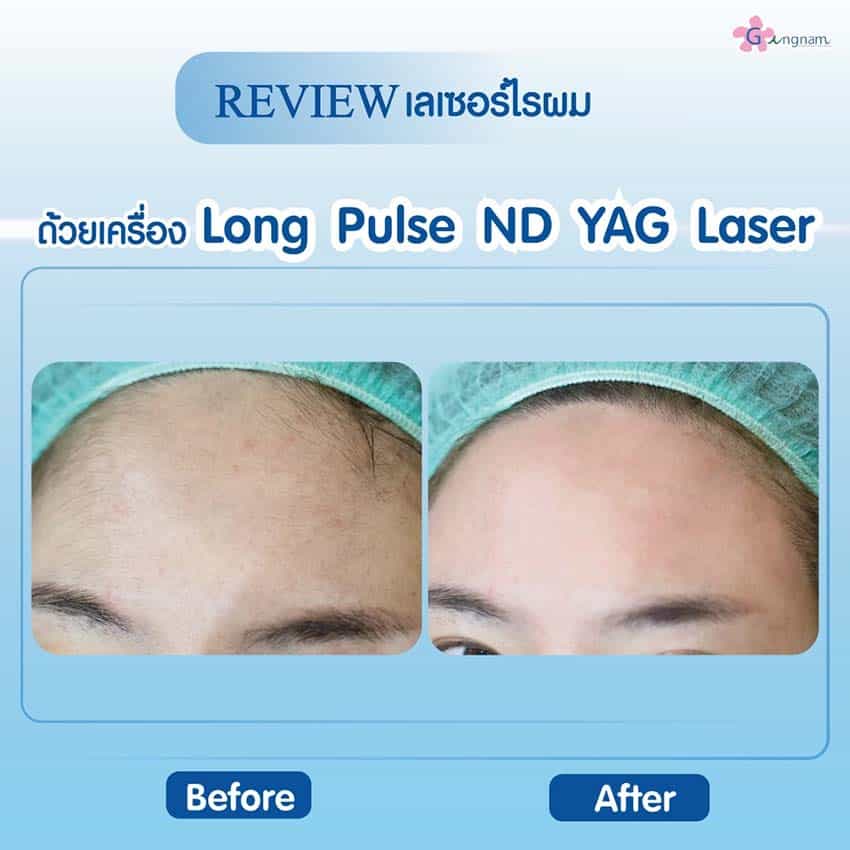 Long Pulse ND Yag กำจัดไรผม