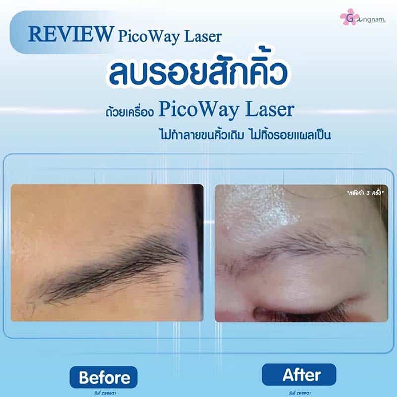 ข้อควรรู้ก่อนลบรอยสักคิ้วด้วยเลเซอร์ ลบคิ้วด้วยวิธีไหนให้เห็นผลและปลอดภัยสุด ข้อควรรู้ก่อนลบรอยสักคิ้วด้วยเลเซอร์ ลบคิ้วด้วยวิธีไหนให้เห็นผลและปลอดภัยสุด