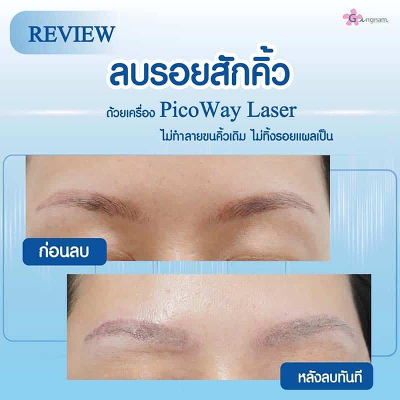ข้อควรรู้ก่อนลบรอยสักคิ้วด้วยเลเซอร์ ลบคิ้วด้วยวิธีไหนให้เห็นผลและปลอดภัยสุด ข้อควรรู้ก่อนลบรอยสักคิ้วด้วยเลเซอร์ ลบคิ้วด้วยวิธีไหนให้เห็นผลและปลอดภัยสุด