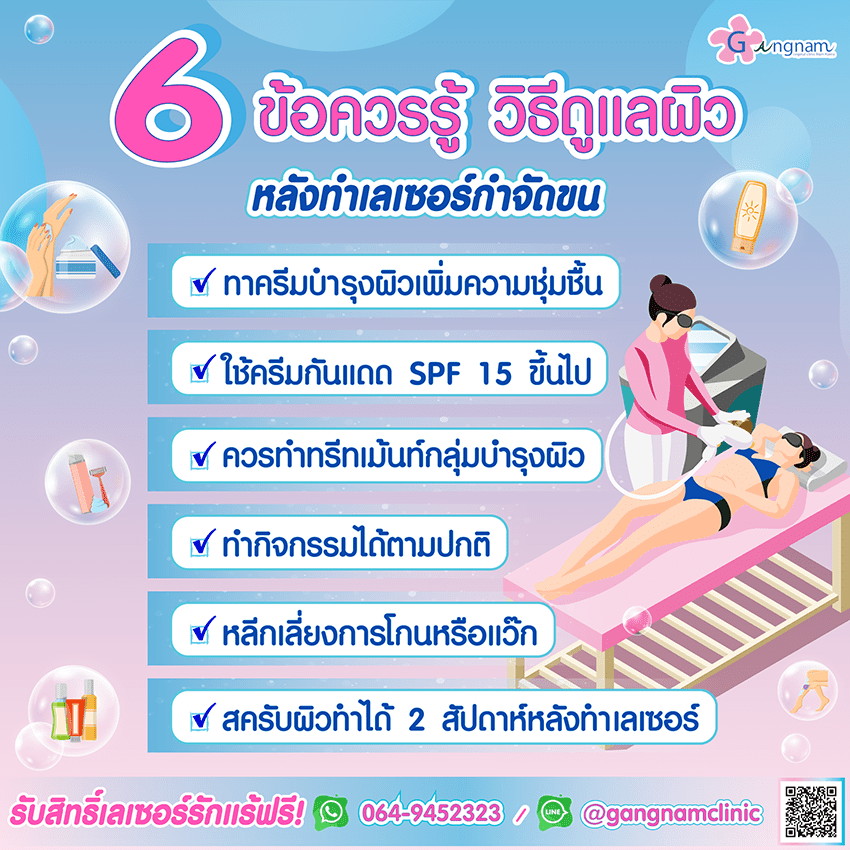 เลเซอร์ขน