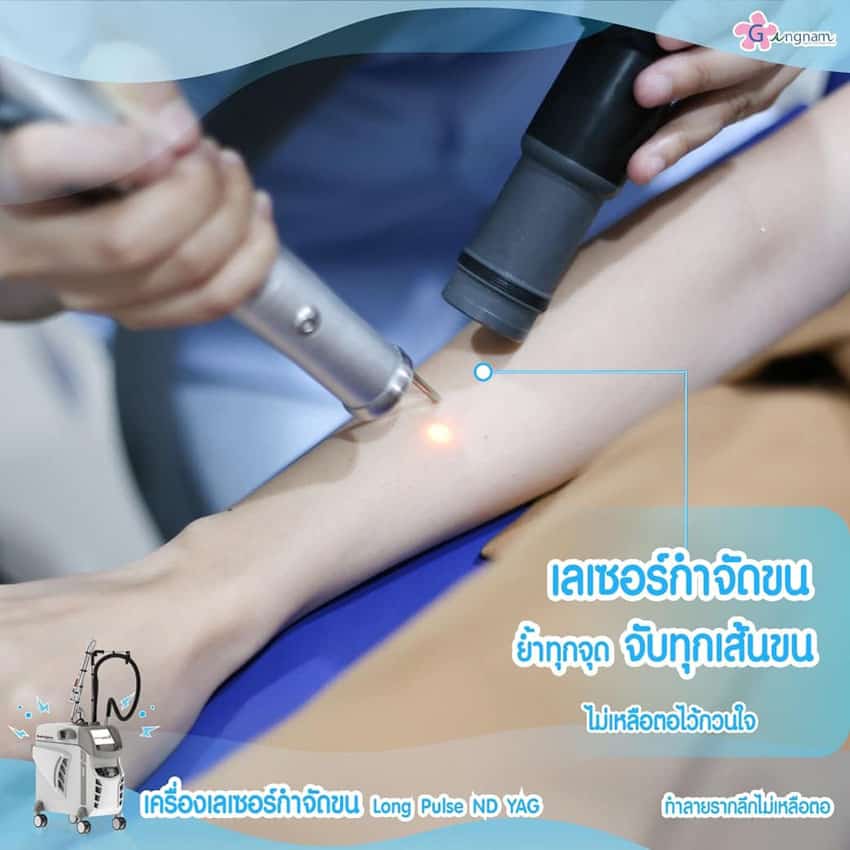 เลเซอร์ขนแขน