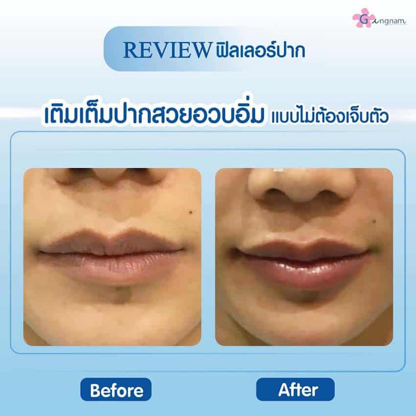 ปากบาง vs ปากสวยอวบอิ่ม