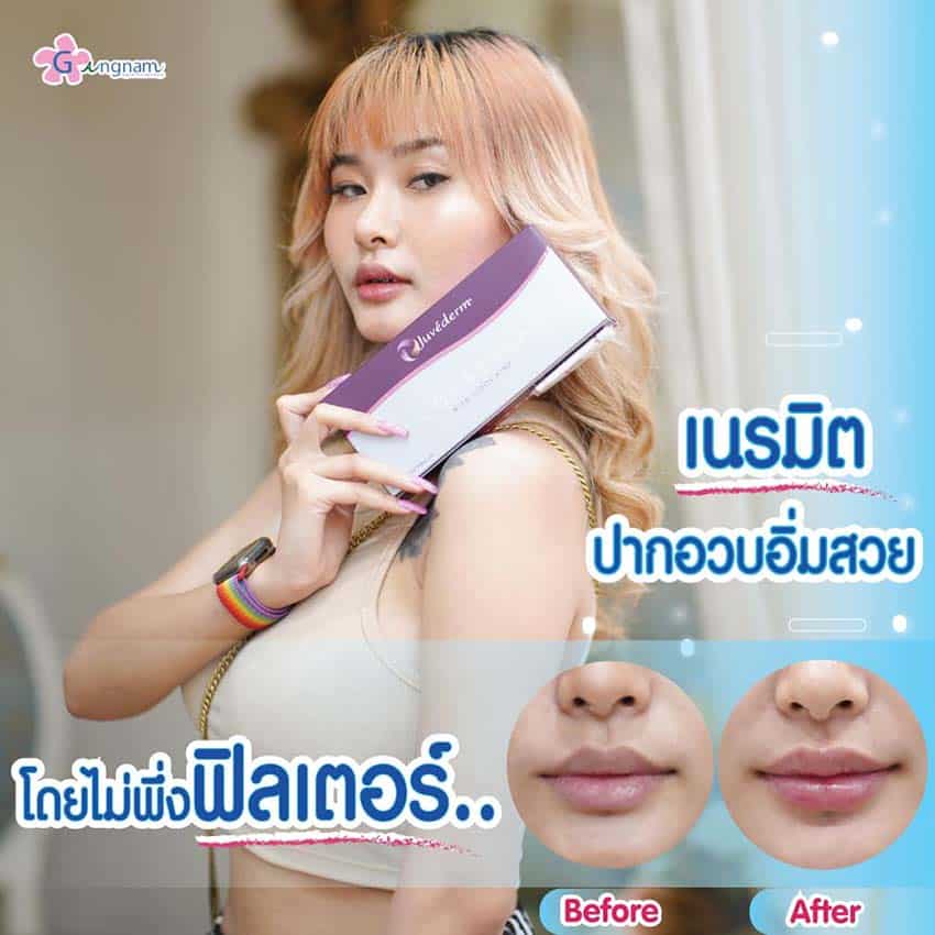 ฟิลเลอร์ช่วยให้ปาก อวบอิ่มได้อย่างไร