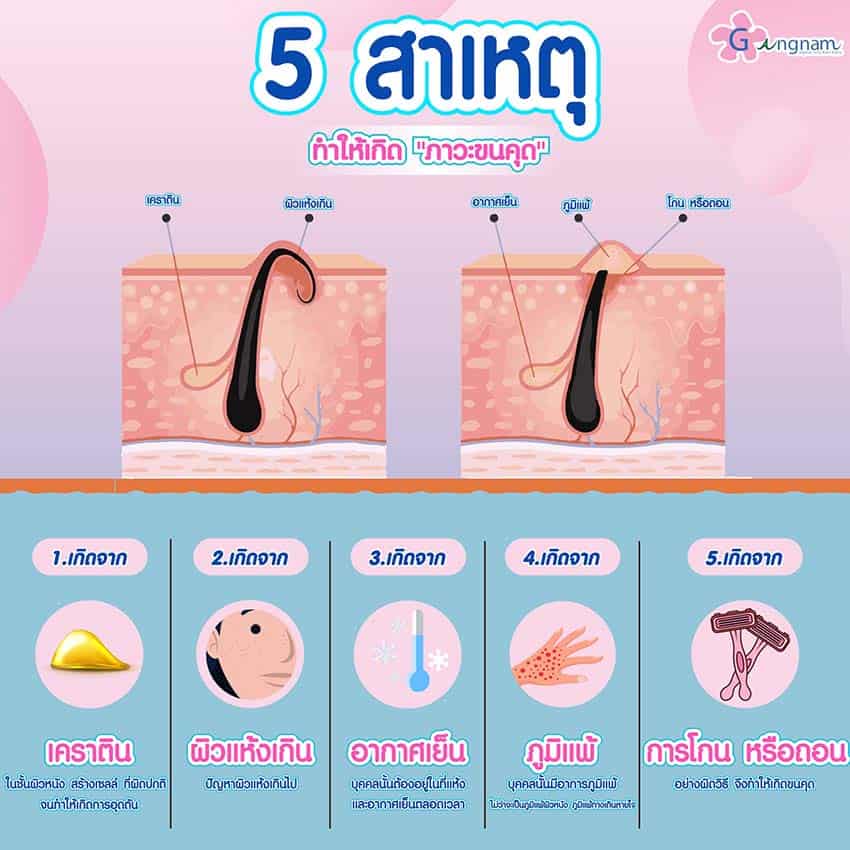 สาเหตุการเกิดขนคุด