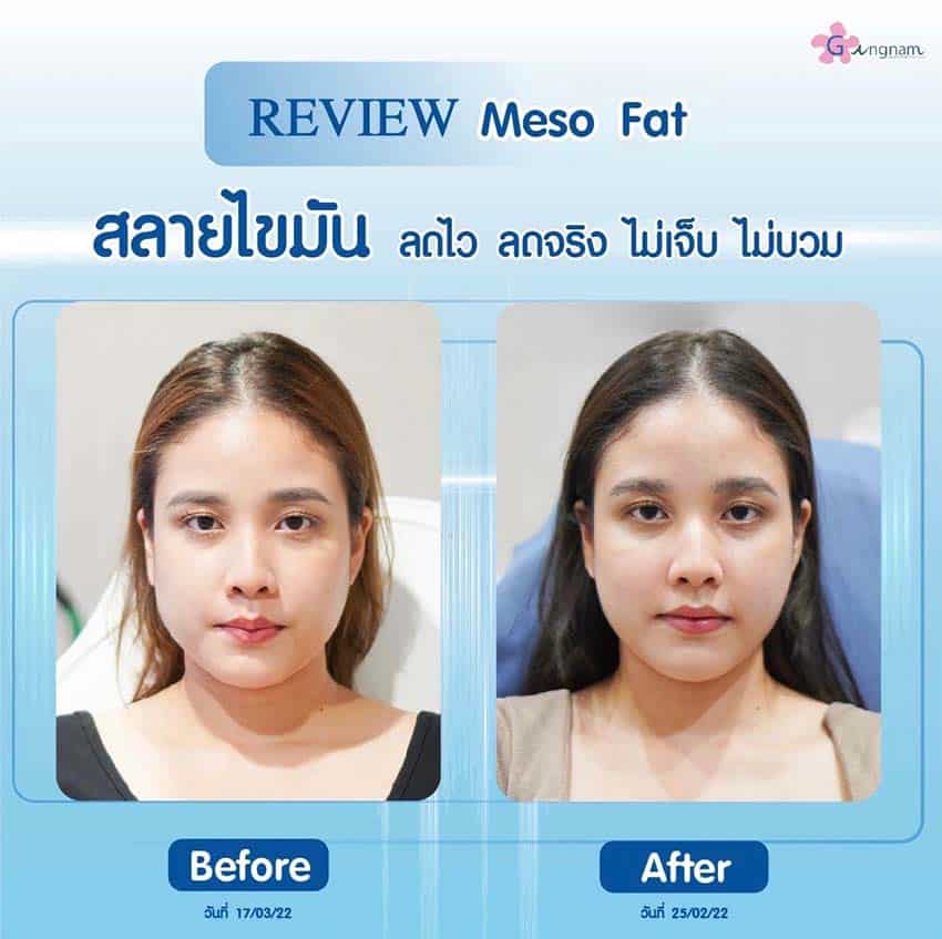 หลัง meso fat สลายไขมันหน้า