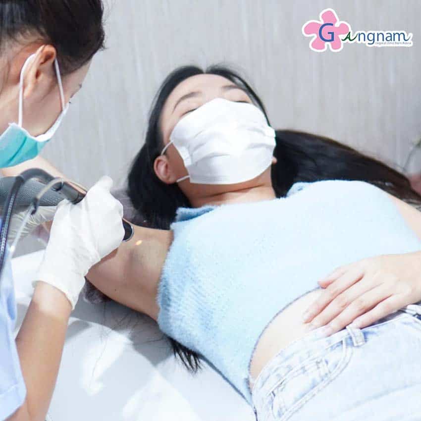 เลเซอร์กำจัดขนลดกลิ่นรักแร้