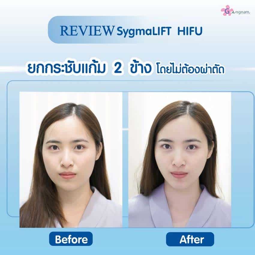 รีวิวยกกระชับหน้าเรียว