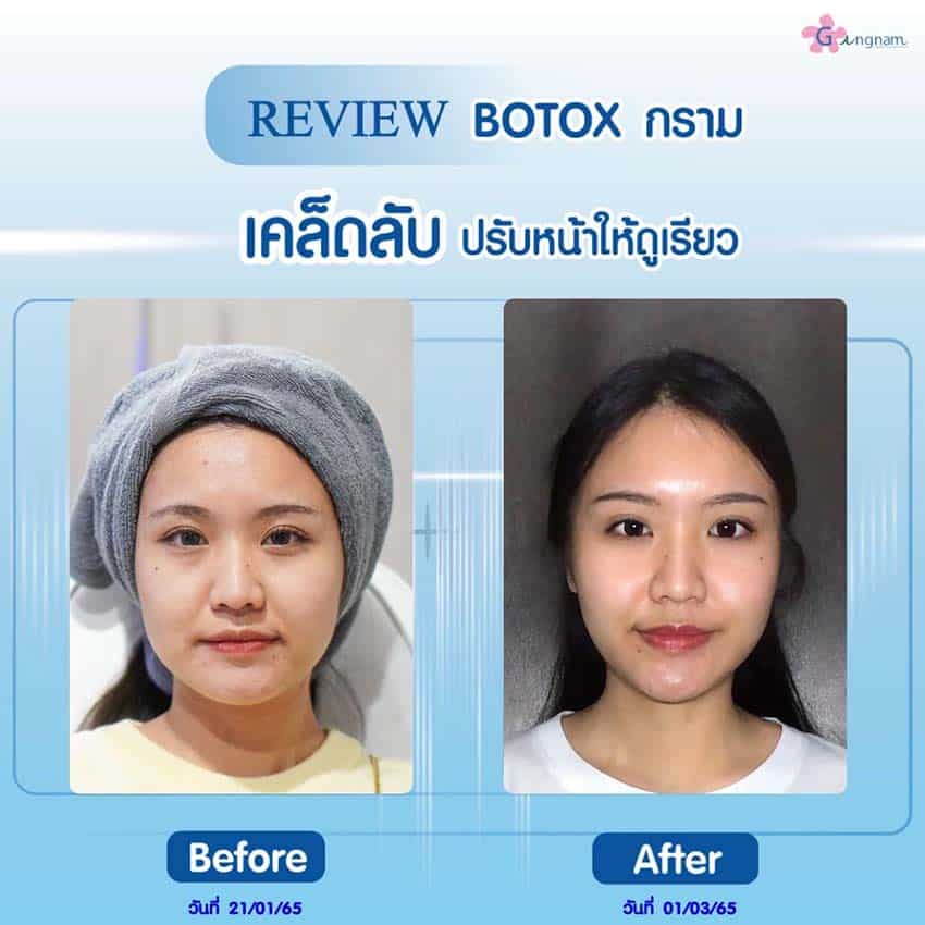 รีวิววิธีฉีดโบท็อกหน้าเรียว