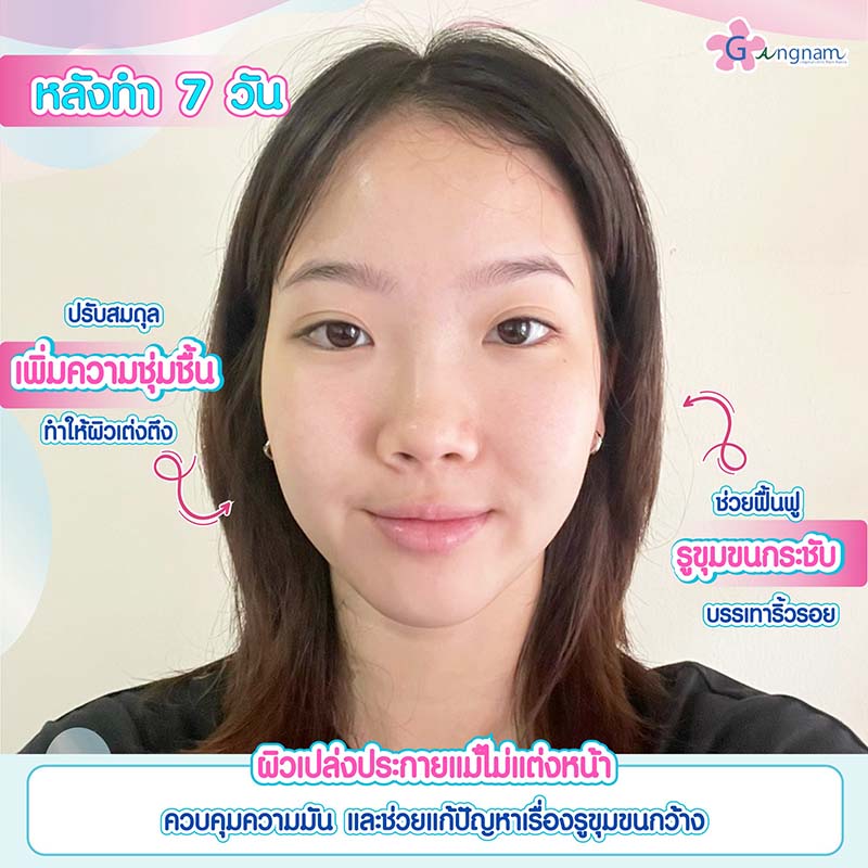 7 วิธีทําให้หน้าใส ไร้สิว วิธีไหนช่วยให้ผิวกระจ่างใสแบบธรรมชาติ และได้ผลจริง 7 วิธีทําให้หน้าใส ไร้สิว วิธีไหนช่วยให้ผิวกระจ่างใสแบบธรรมชาติ และได้ผลจริง