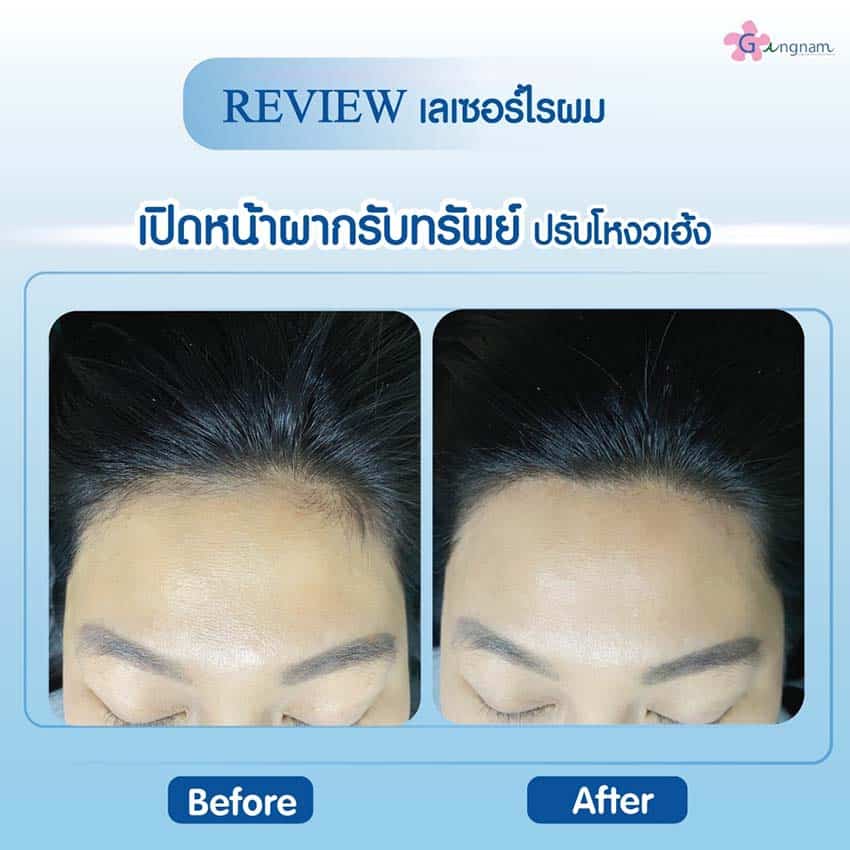 รีวิวเลเซอร์ไรผม