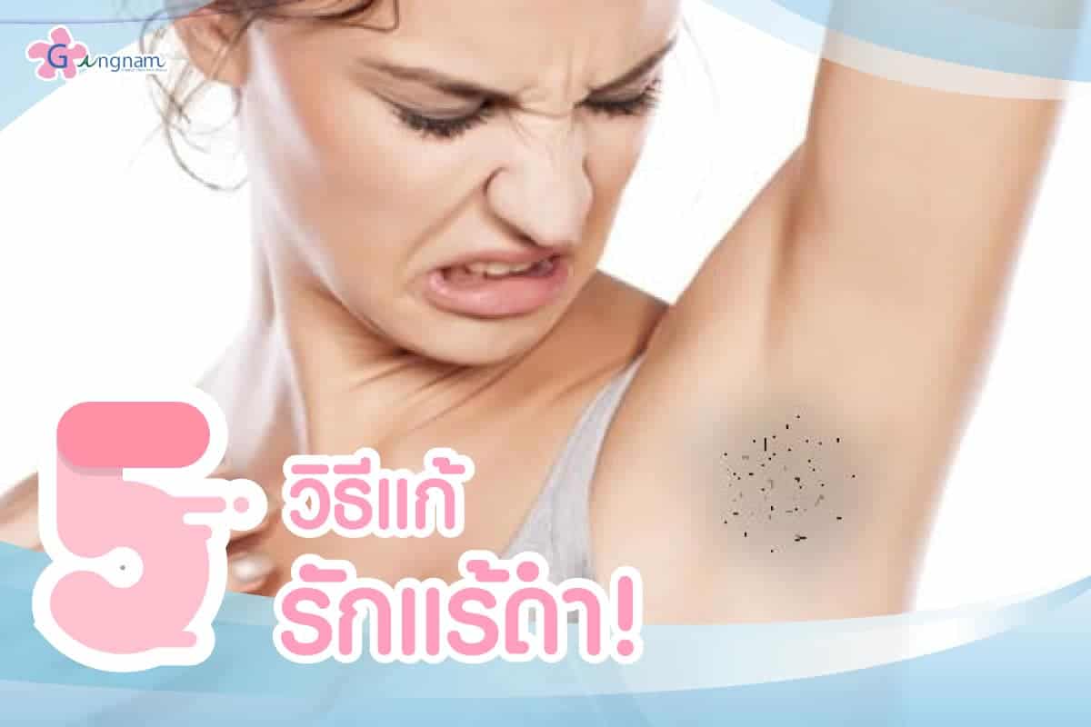 รักแร้ดำ เกิดจากอะไร? พร้อมแนะนำ 8 วิธีแก้รักแร้ดำแบบเร่งด่วน รักแร้ดำ เกิดจากอะไร? พร้อมแนะนำ 8 วิธีแก้รักแร้ดำแบบเร่งด่วน