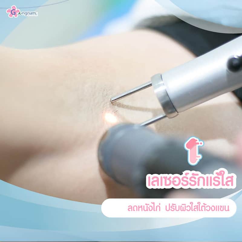 รักแร้ดำ เกิดจากอะไร? พร้อมแนะนำ 8 วิธีแก้รักแร้ดำแบบเร่งด่วน รักแร้ดำ เกิดจากอะไร? พร้อมแนะนำ 8 วิธีแก้รักแร้ดำแบบเร่งด่วน