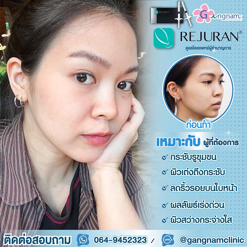 7 วิธีทําให้หน้าใส ไร้สิว วิธีไหนช่วยให้ผิวกระจ่างใสแบบธรรมชาติ และได้ผลจริง 7 วิธีทําให้หน้าใส ไร้สิว วิธีไหนช่วยให้ผิวกระจ่างใสแบบธรรมชาติ และได้ผลจริง