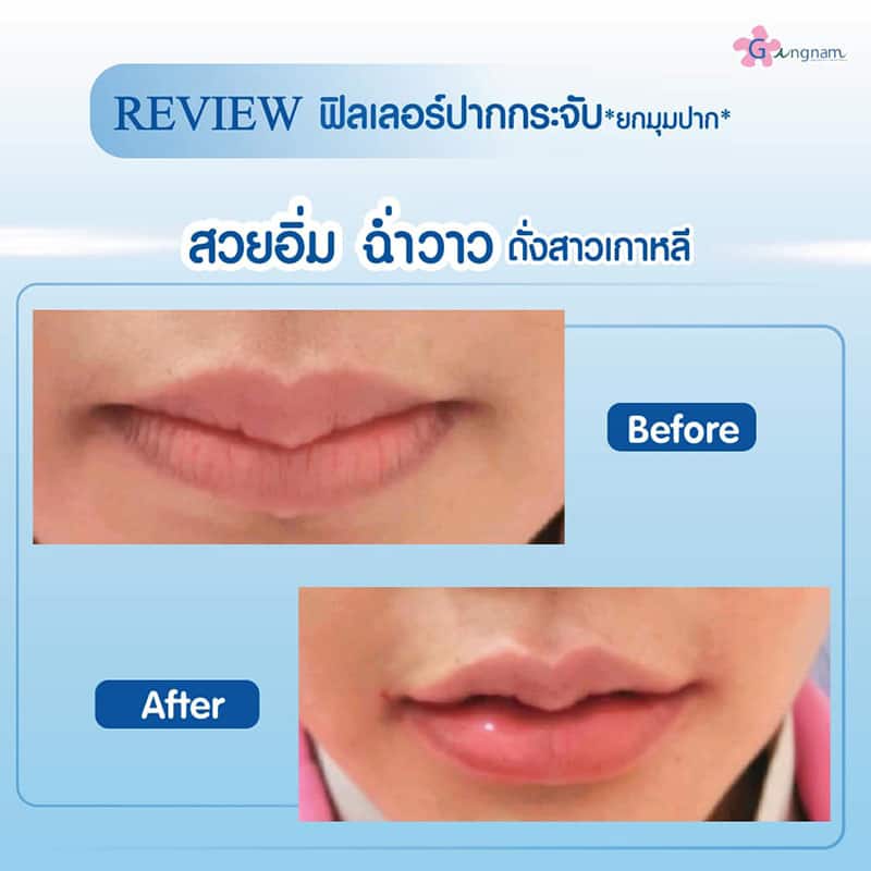 ฉีดฟิลเลอร์ ทำปากกระจับ