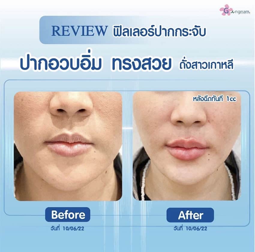 ฉีดฟิลเลอร์แก้ปากเป็นร่อง