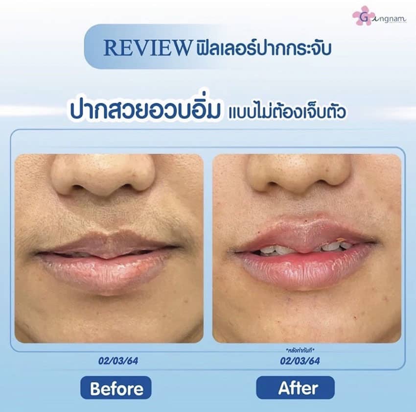 รีวิวแก้ปากแห้ง ปากแตก