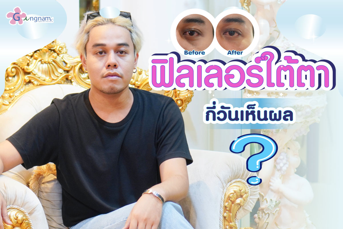 ฉีดฟิลเลอร์ใต้ตา กี่วันเห็นผล