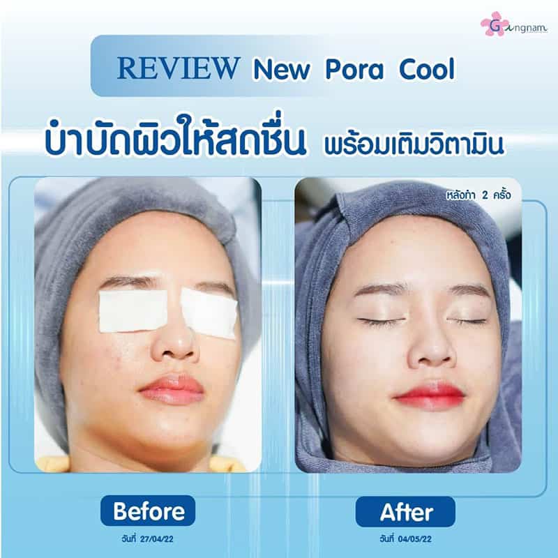New Pora Cool แก้สิวผด