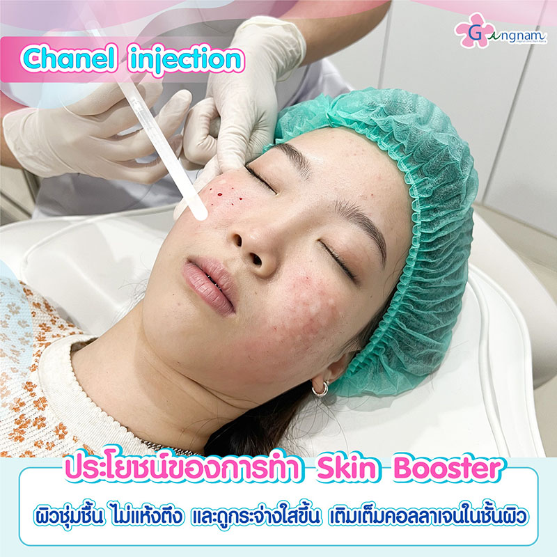 ฉีด Chanel injection ลดสิวผด