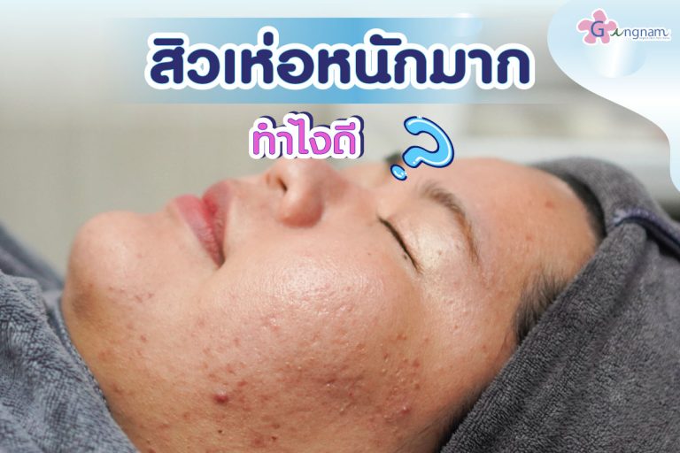 สิวเห่อหนักมาก ทำไงดี?  สาเหตุเกิดจากอะไร  มีวิธีรักษาให้หายได้อย่างไร?