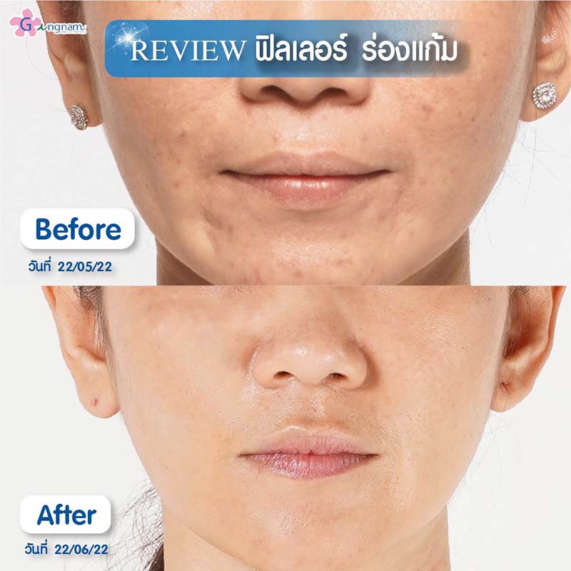 ฉีดฟิลเลอร์ร่องแก้ม
