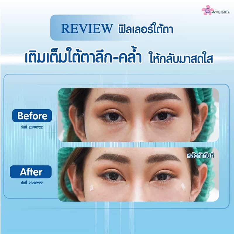 ฉีดฟิลเลอร์ใต้ตา 1cc