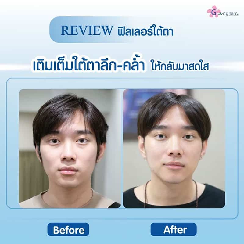 ฟิลเลอร์ใต้ตา ผู้ชาย