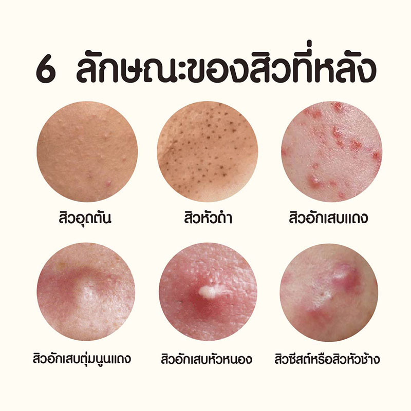 สาเหตุปัญหาสิวที่หลัง เกิดจากอะไร? พร้อมแนะนำวิธีป้องกันและรักษาให้หายขาด สาเหตุปัญหาสิวที่หลัง เกิดจากอะไร? พร้อมแนะนำวิธีป้องกันและรักษาให้หายขาด