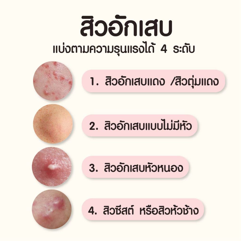 สิวอักเสบ มีกี่แบบ