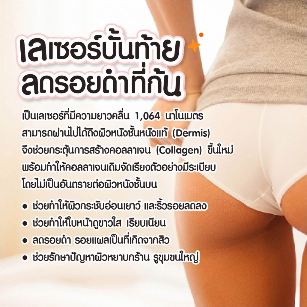 ก้นดำ ก้นลาย เกิดจากอะไร มีวิธีแก้ยังไง? ให้บั้นท้ายกลับมาเนียน ก้นดำ ก้นลาย เกิดจากอะไร มีวิธีแก้ยังไง? ให้บั้นท้ายกลับมาเนียน