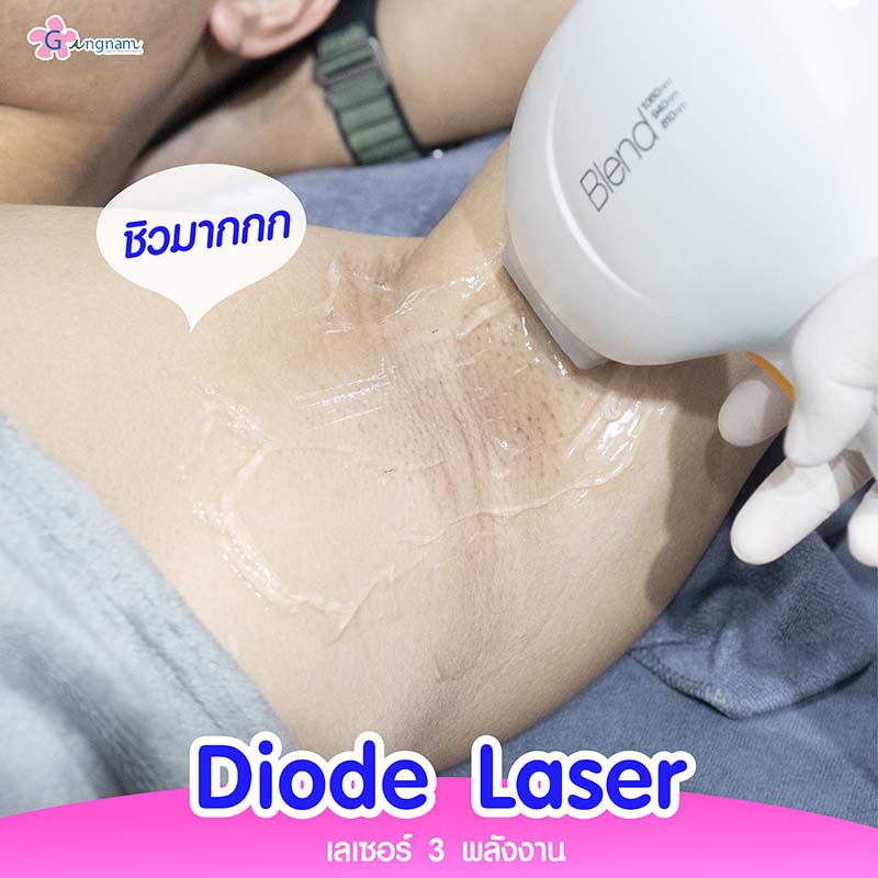 ขั้นตอน diode laser