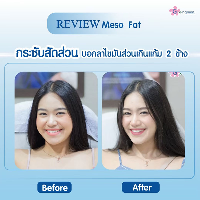 ฉีดเมโสแฟต ลดไขมันแก้ม 4 ครั้ง