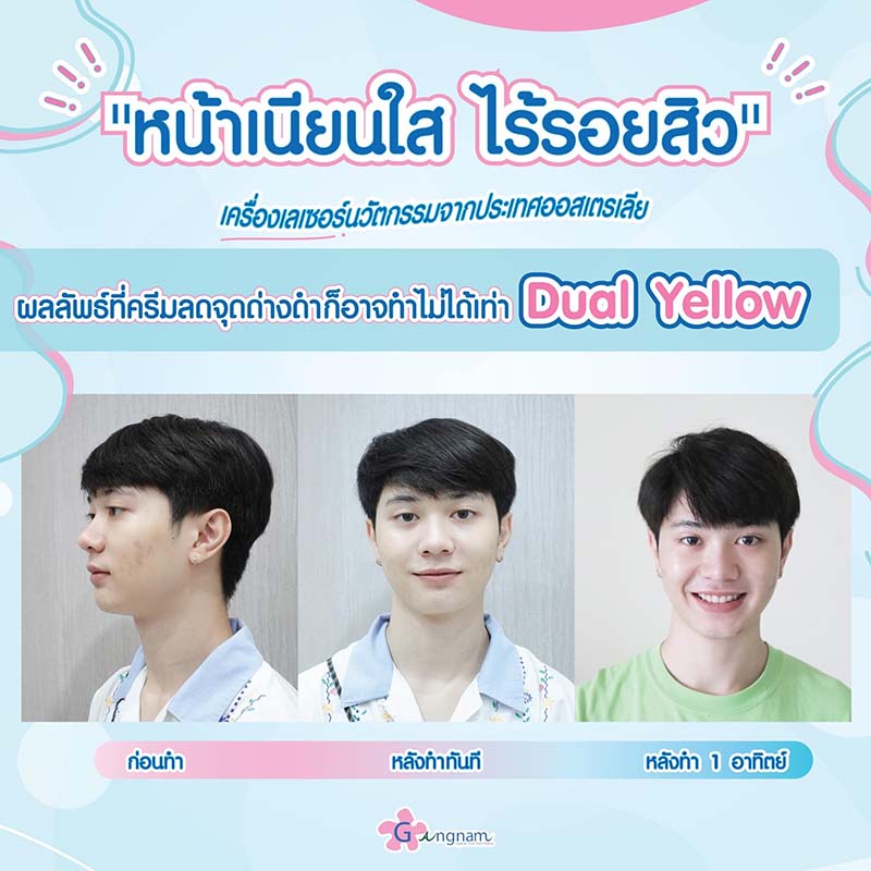 ตัวอย่างหลังทำ dual yellow