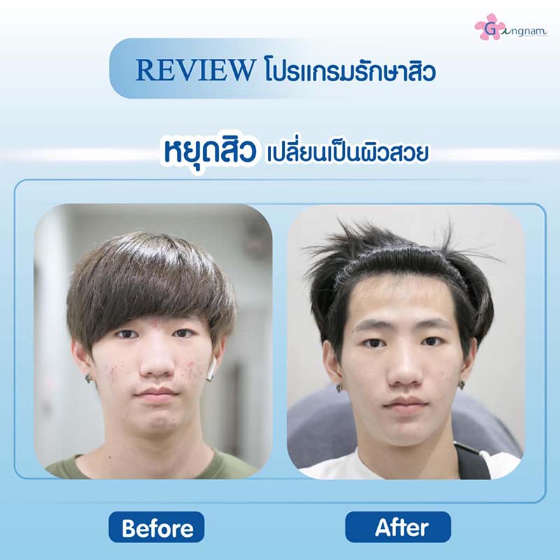 รีวิวโปรแกรมลดรอยสิวผู้ชาย