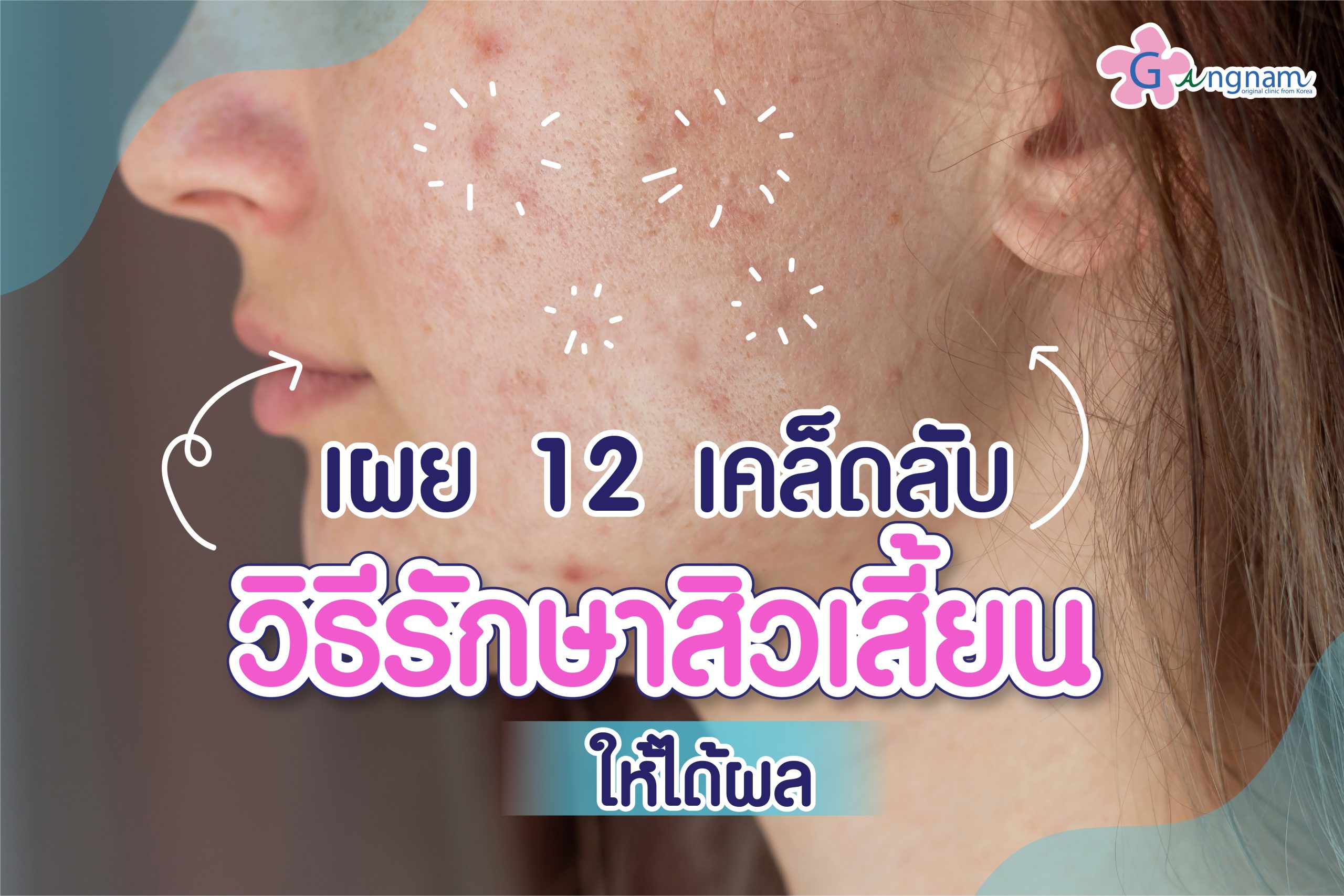วิธีรักษาสิวเสี้ยนให้ได้ผล