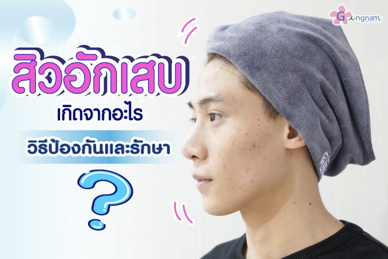 สิวอักเสบ คืออะไร ? พร้อมแนะนำวิธีดูแล และรักษาให้ได้ผลแบบธรรมชาติ