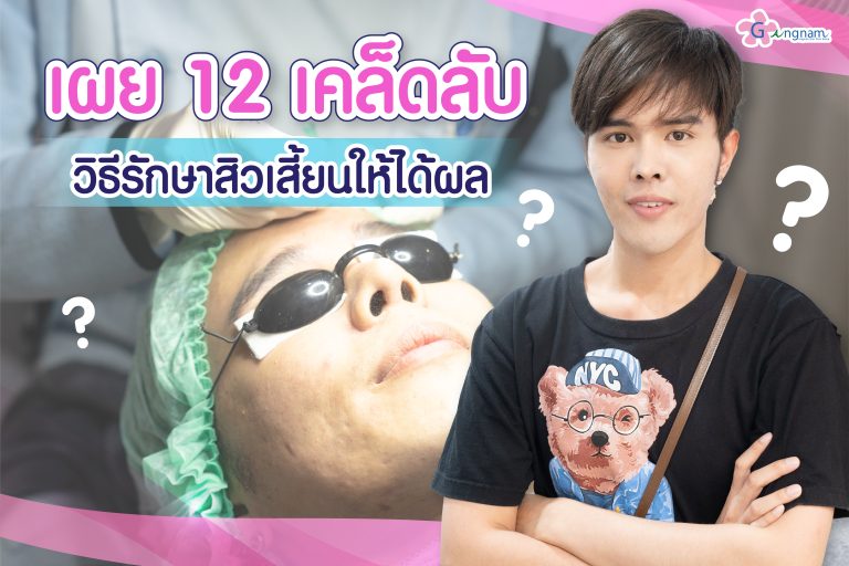 เผย 12 เคล็ดลับวิธีรักษาสิวเสี้ยนให้ได้ผล